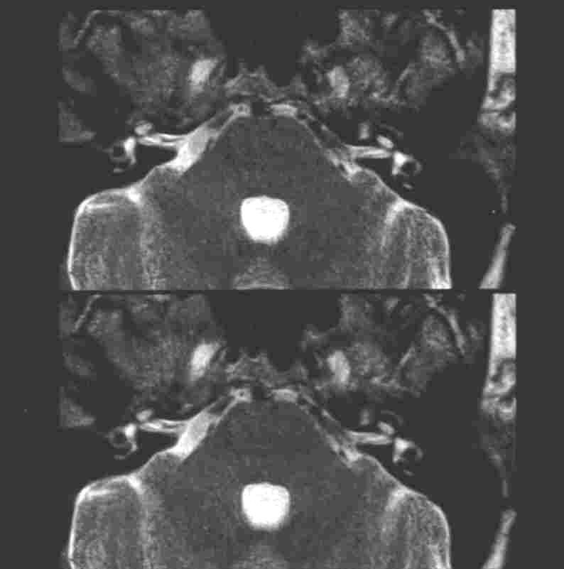 MRT Kleinhirnbrückenwinkel