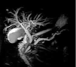 MRCP - MRT Gallenwege und Bauchspeicheldrüsengang