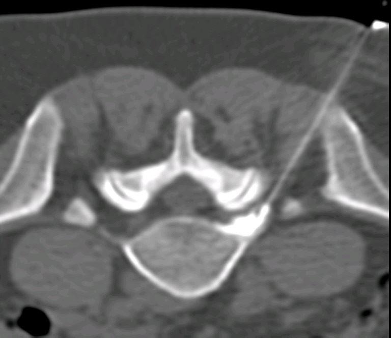 Periradikuläre Therapie