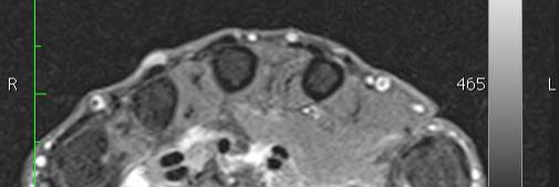 MRT Rheuma Handgelenk