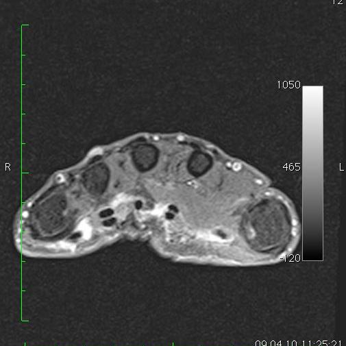 MRT Rheuma Handgelenk