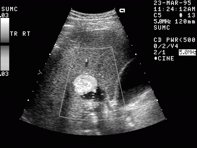 Ultraschallbild eines Leberhämangioms - Sonographie